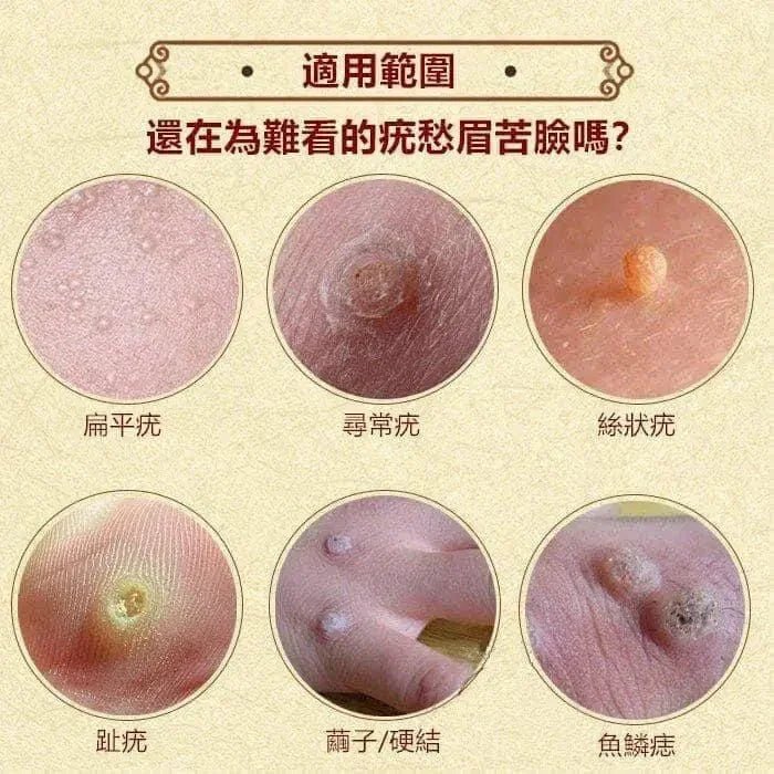 日本製 日本皮膚強力推薦 去疣神膏 10g |炎症| 疣皮膚病| 傷痕 | 燙傷 |粉刺 - HLY & CHOCCICO