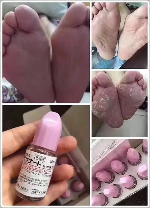 日本製🇯🇵 日本鳥居製藥抗真菌水 10ml |日本醫生大力推薦| - HLY & CHOCCICO