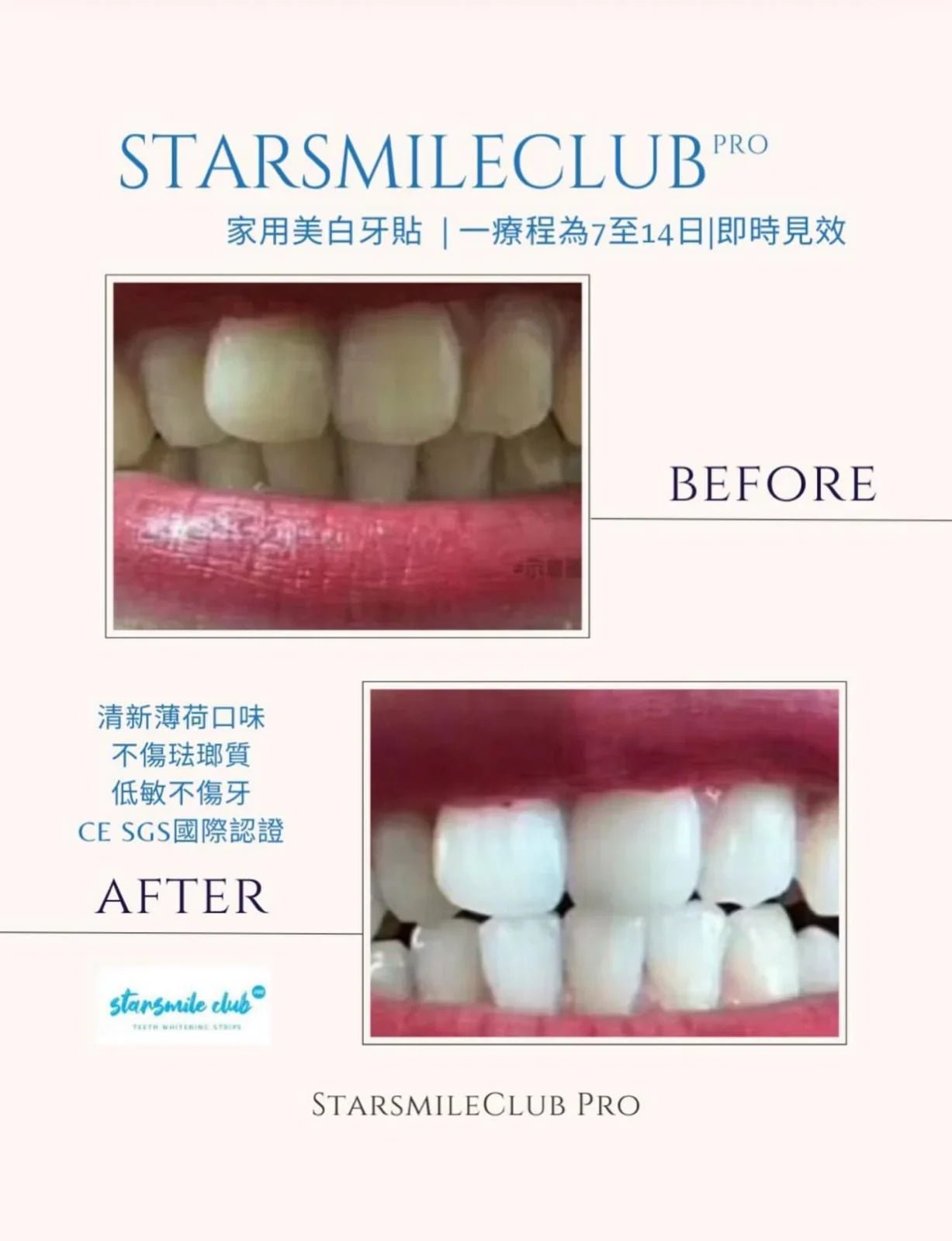 𝐒𝐭𝐚𝐫𝐬𝐦𝐢𝐥𝐞𝐂𝐥𝐮𝐛 𝐏𝐫𝐨 專業🇺🇸美白牙齒貼 (7p) - HLY & CHOCCICO