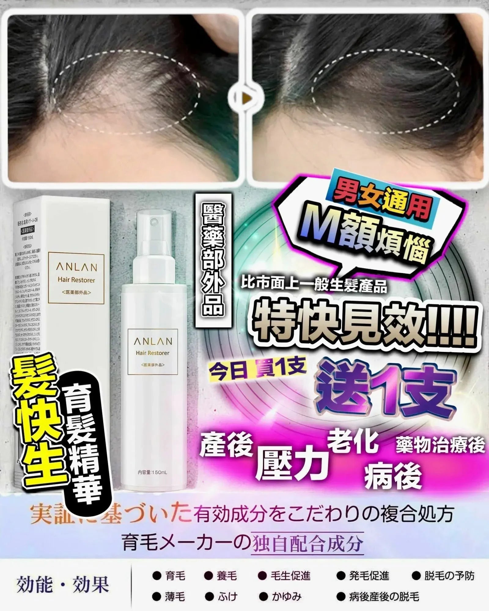Anlan 髮快生 育髮精華 150ml‼️買1送1‼️ - HLY & CHOCCICO