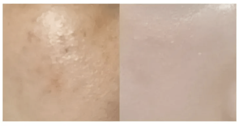 ★ Dr.Melaxin 逆齢專家 TX 超強 去角質美白爽膚水 150ml HLY & CHOCCICO