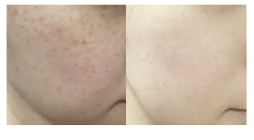 ★ Dr.Melaxin 逆齢專家 TX 超強 去角質美白爽膚水 150ml HLY & CHOCCICO