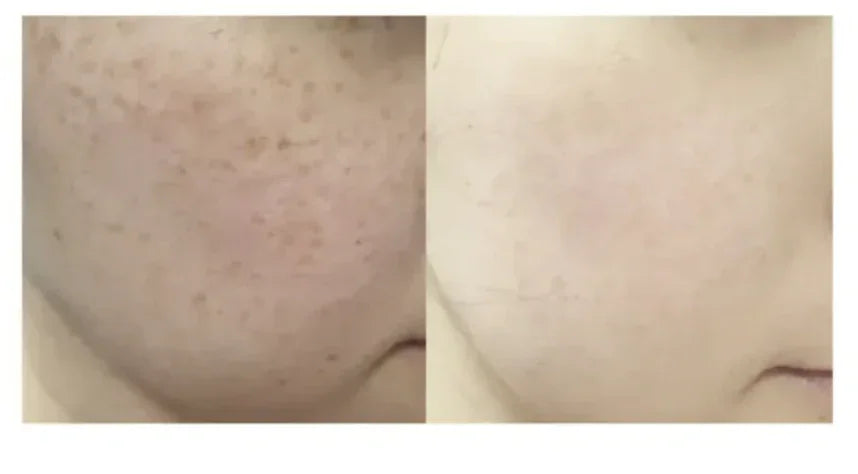 ★ Dr.Melaxin 逆齢專家 TX 超強 去角質美白爽膚水 150ml - HLY & CHOCCICO