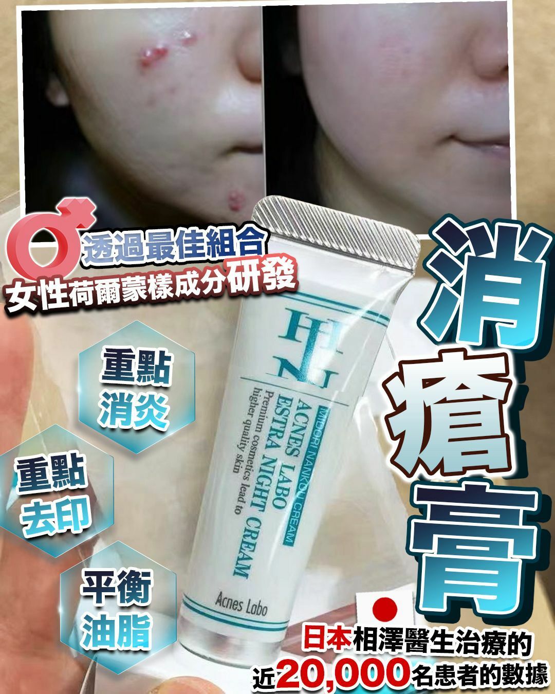 日本 HIN 消瘡膏 ✨送 15張貼 - HLY & CHOCCICO