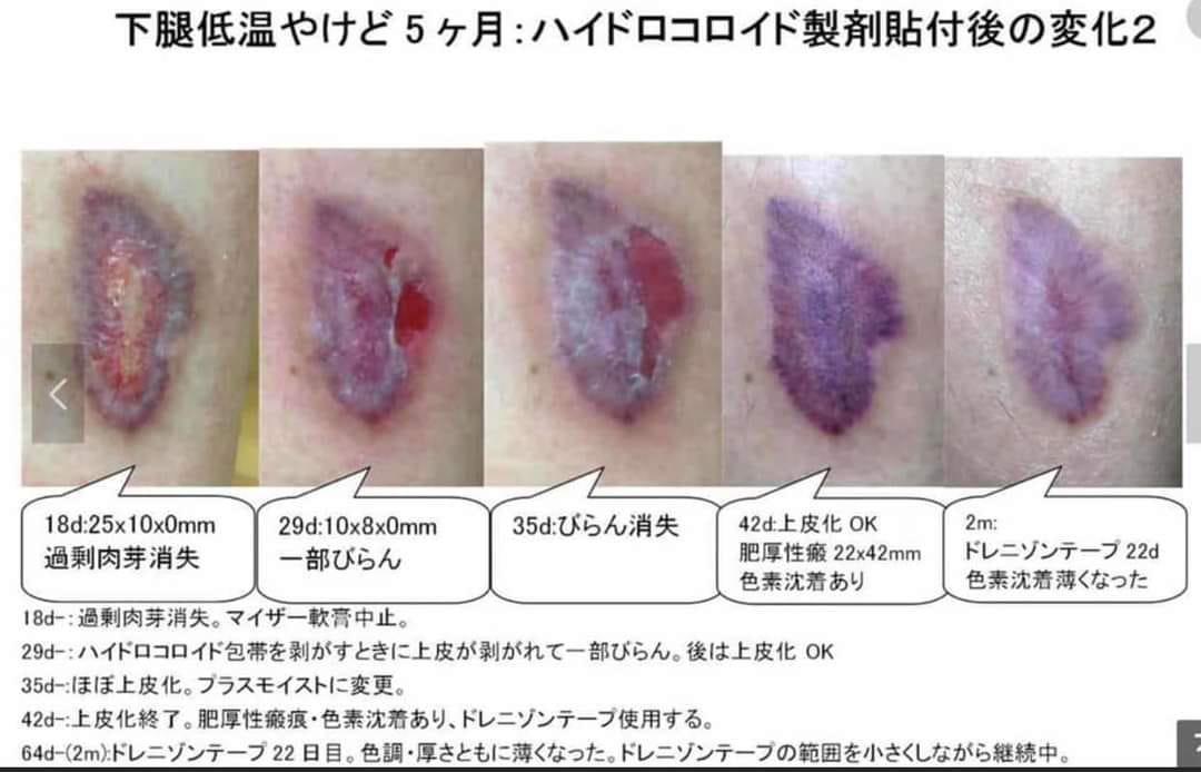 日本🇯🇵 Hisamitsu 久光疤痕修復去疤貼 1包1枚 - HLY & CHOCCICO
