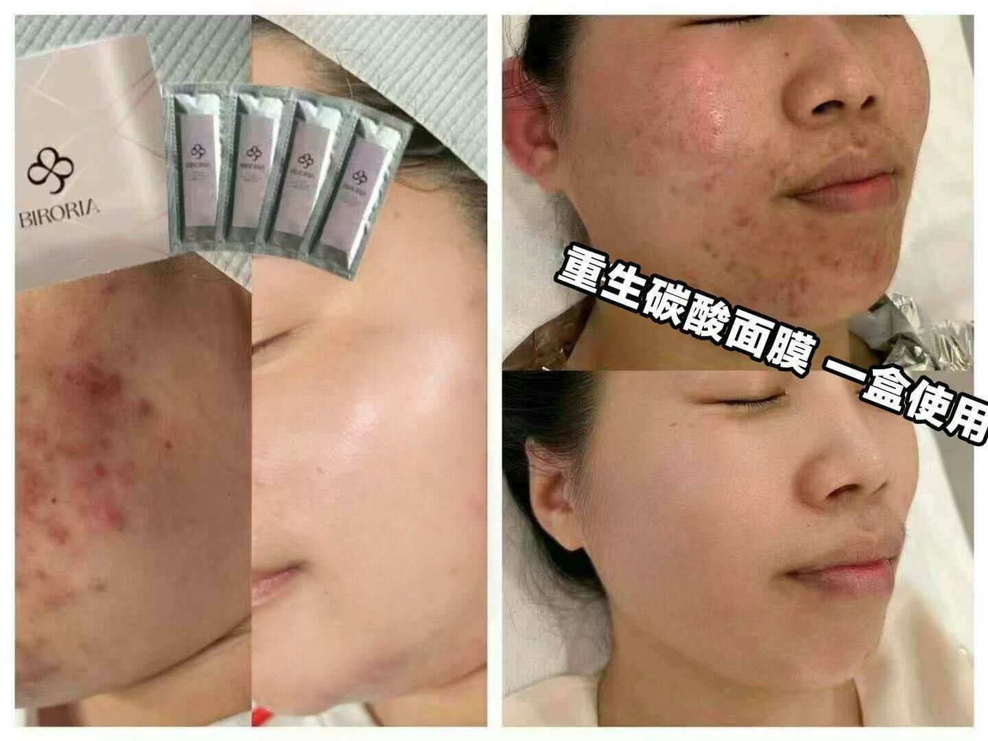 CO2重生碳酸面膜 - HLY & CHOCCICO