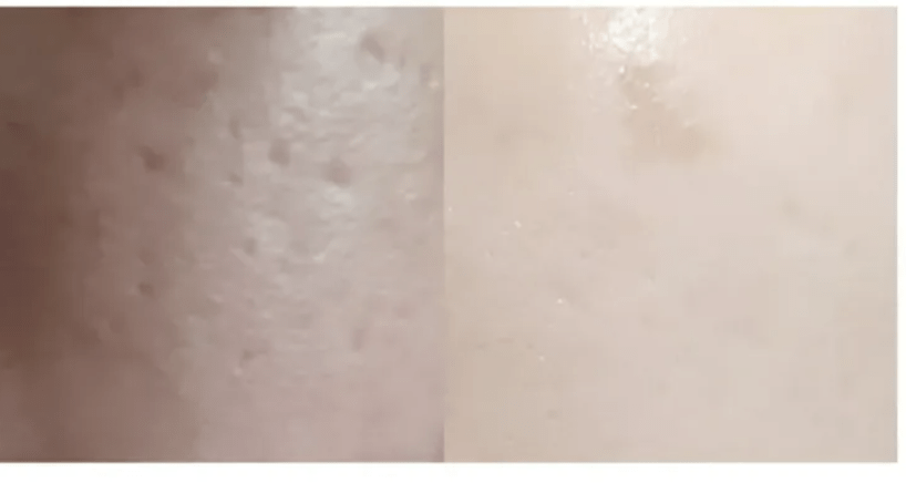 ★ Dr.Melaxin 逆齢專家 TX 超強 去角質美白爽膚水 150ml HLY & CHOCCICO