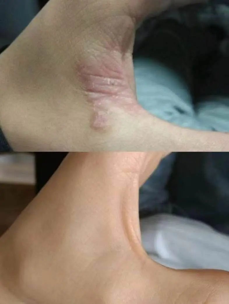 MSOP濕疹修復皇 ✨買一送一 - HLY & CHOCCICO