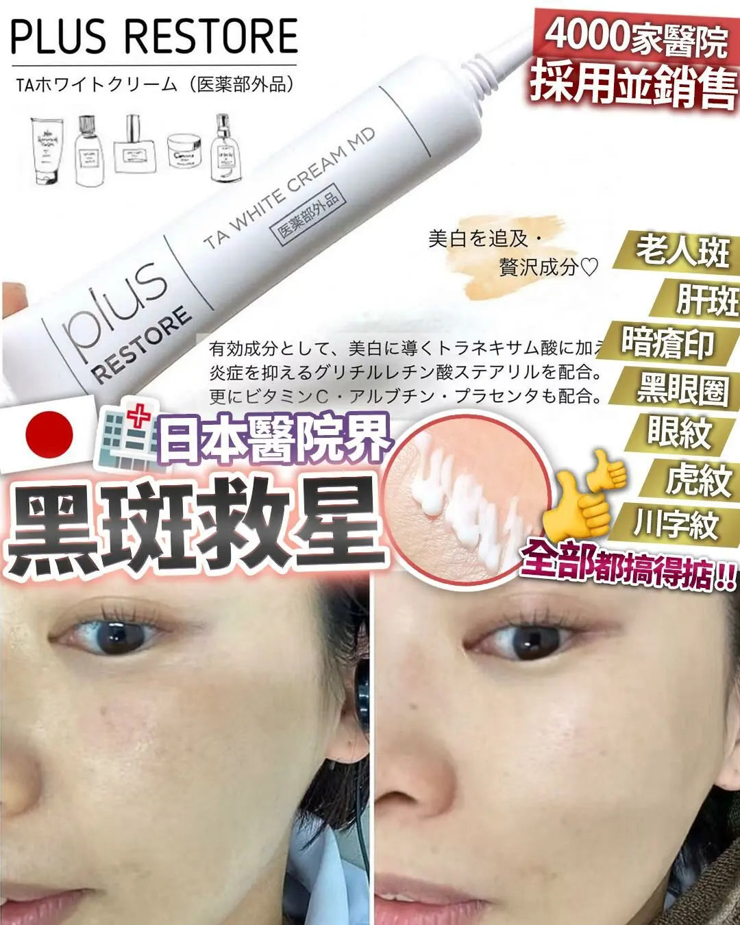 日本 醫療級 黑斑救星 Plus Restore TA White Cream MD 10g - HLY & CHOCCICO