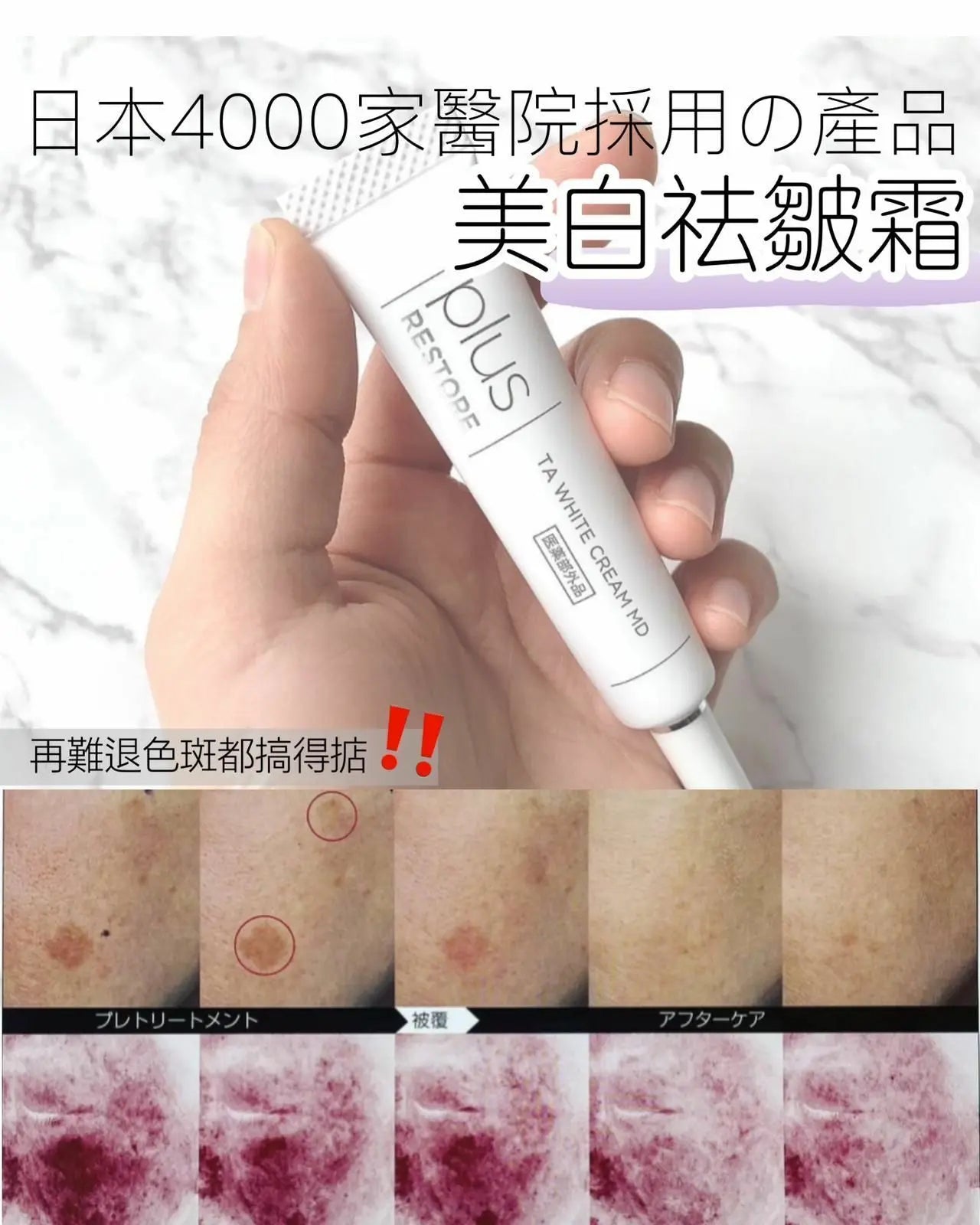 日本 醫療級 黑斑救星 Plus Restore TA White Cream MD 10g - HLY & CHOCCICO
