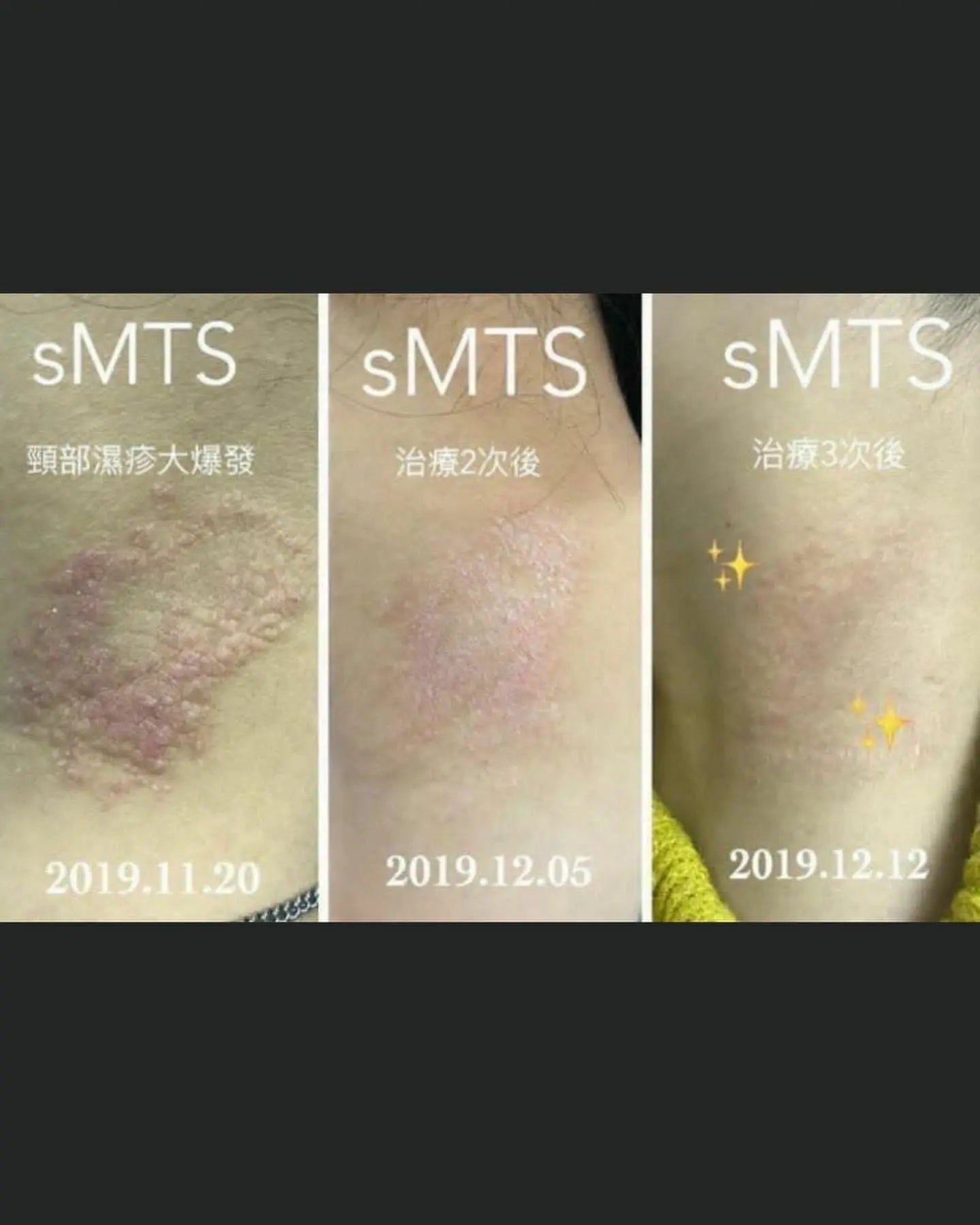 sMTS  嬰兒水晶針水光粒子面膜 (1盒5片) - HLY & CHOCCICO