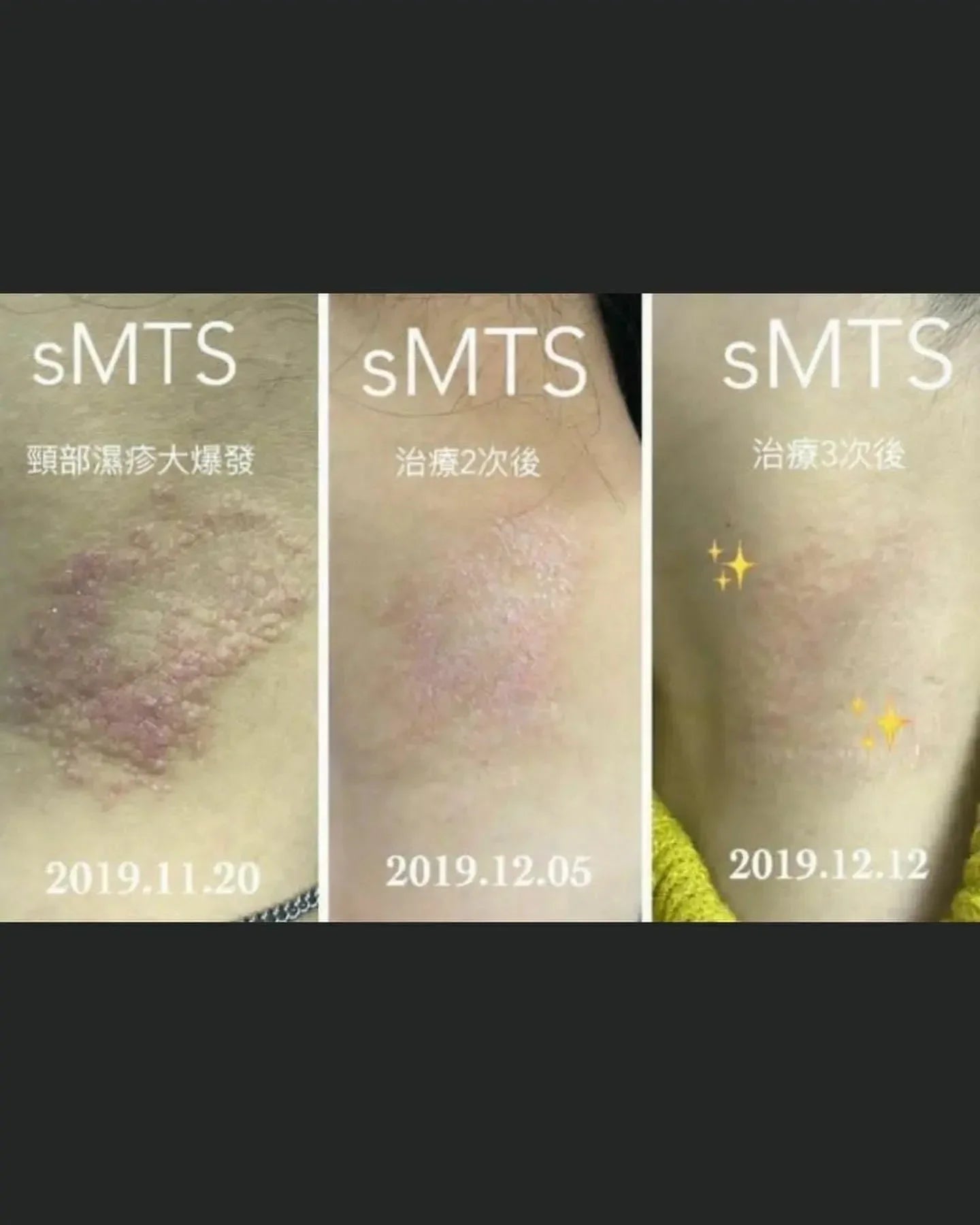 sMTS 嬰兒水晶針水光粒子面膜 (1盒5片) - HLY & CHOCCICO