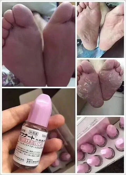 日本製🇯🇵 日本鳥居製藥抗真菌水 10ml |日本醫生大力推薦| - HLY &amp; CHOCCICO