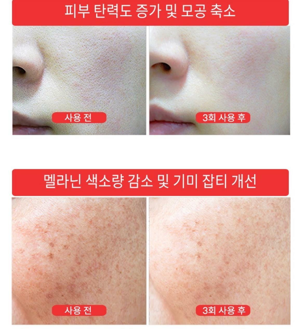 【一口價$550/套】韓國製🇰🇷 LUTHIONE白玉美白針淡斑安瓶優惠套裝 HLY & CHOCCICO