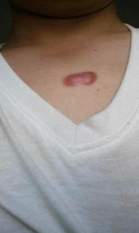 日本🇯🇵 Hisamitsu 久光疤痕修復去疤貼 1包1枚