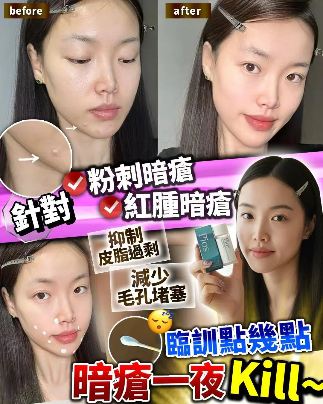 PIOS Instant Acne-Removing Essence｜KILL overnight to remove acne marks and eliminate acne|