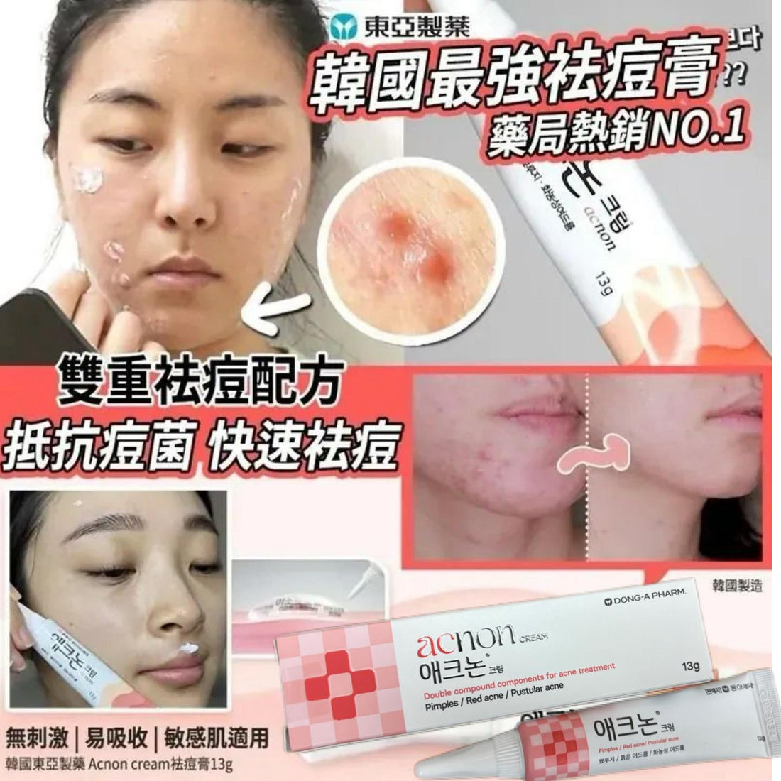 韓國東亞製藥 Acnon 消炎殺菌暗瘡膏 Acnon Cream 13g