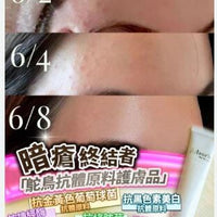 日本 Adsorb 暗瘡終結者 25g HLY & CHOCCICO