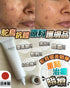 日本 Adsorb 暗瘡終結者 25g - HLY & CHOCCICO