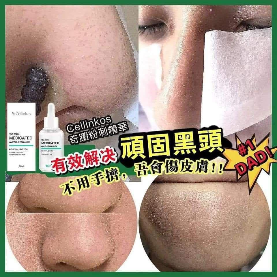 📢韓國爆單皇！Cellinkos 粉刺精華 - HLY &amp; CHOCCICO