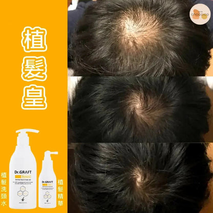 韓國🇰🇷Dr.GRAFT 植髮皇 孕育洗頭水300ml/ 孕育精華100ml - HLY &amp; CHOCCICO