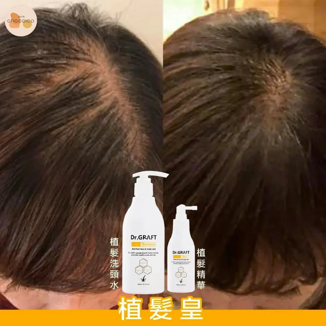 韓國🇰🇷Dr.GRAFT 植髮皇 孕育洗頭水300ml/ 孕育精華100ml - HLY &amp; CHOCCICO