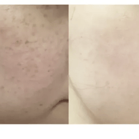 ★ Dr.Melaxin 逆齢專家 TX 超強 去角質美白爽膚水 150ml HLY & CHOCCICO