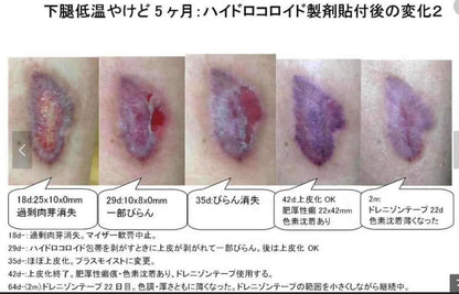 日本🇯🇵 Hisamitsu 久光疤痕修復去疤貼 1包1枚 - HLY &amp; CHOCCICO