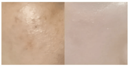 ★ Dr.Melaxin 逆齢專家 TX 超強 去角質美白爽膚水 150ml HLY &amp; CHOCCICO