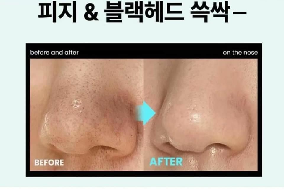 韓國Ilso黑頭軟化導出液 x 圓頭黑頭鏟 套裝 - HLY & CHOCCICO