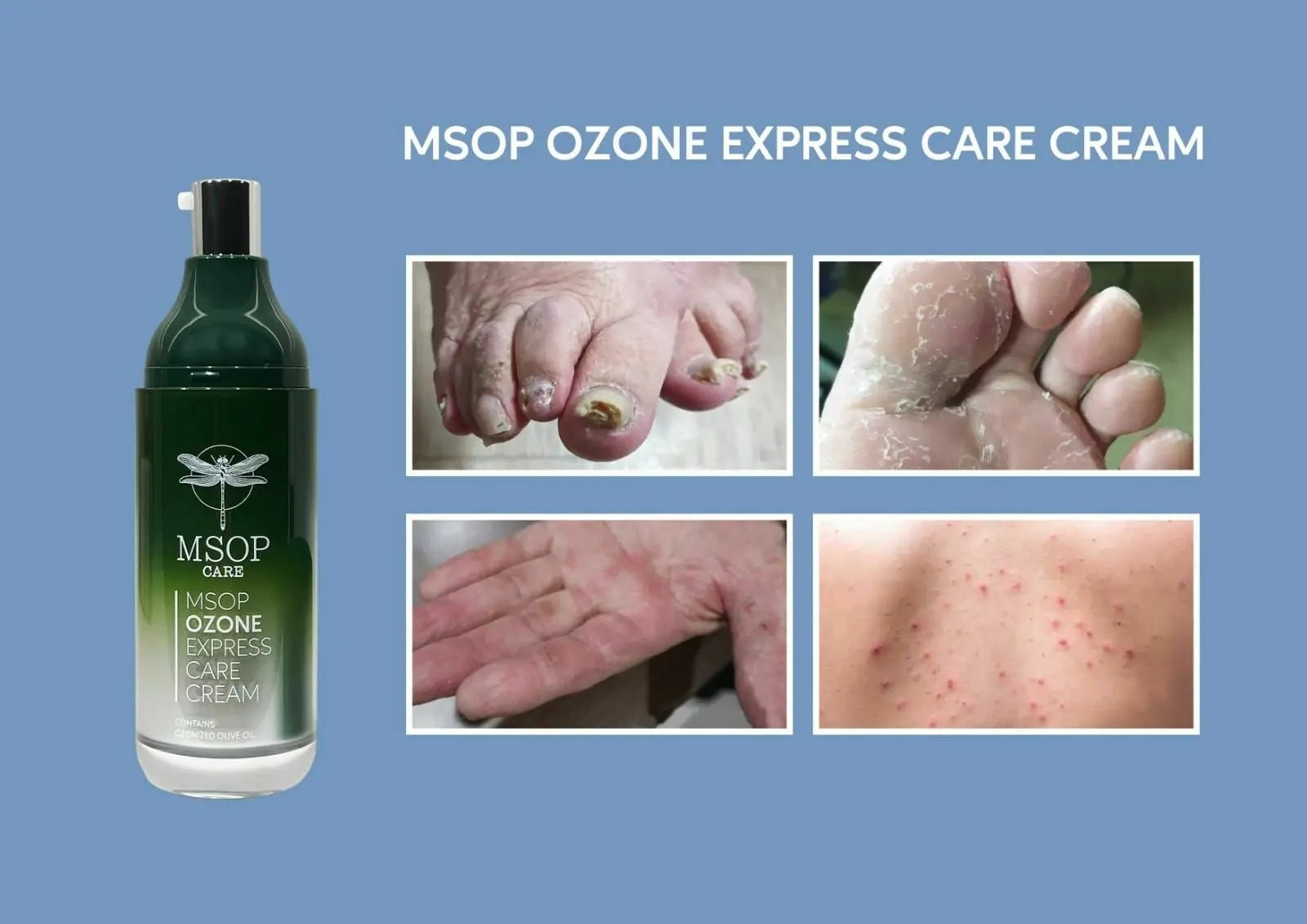 MSOP濕疹修復皇 ✨買一送一 - HLY & CHOCCICO