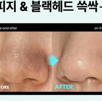 韓國Ilso黑頭軟化導出液 x 圓頭黑頭鏟 套裝 - HLY & CHOCCICO