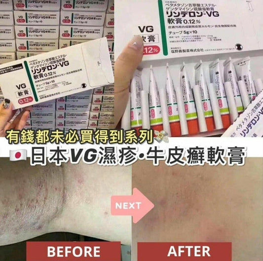 【一口價$60/支】日本VG濕疹軟膏 5g |濕疹|皮膚過敏|黑皮症|股癬|苔蘚|皮膚炎|癢疹|膿皰|紅斑|