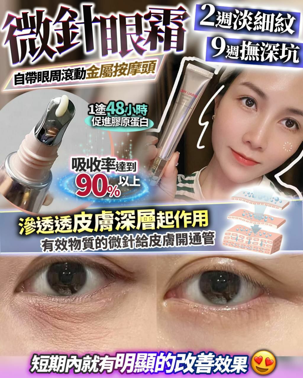 微針眼 - HLY & CHOCCICO