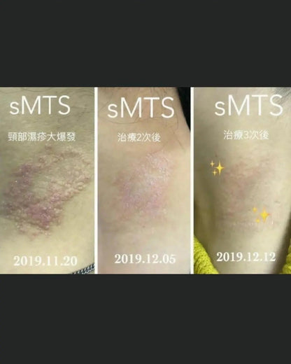 sMTS  嬰兒水晶針水光粒子面膜 (1盒5片) - HLY &amp; CHOCCICO