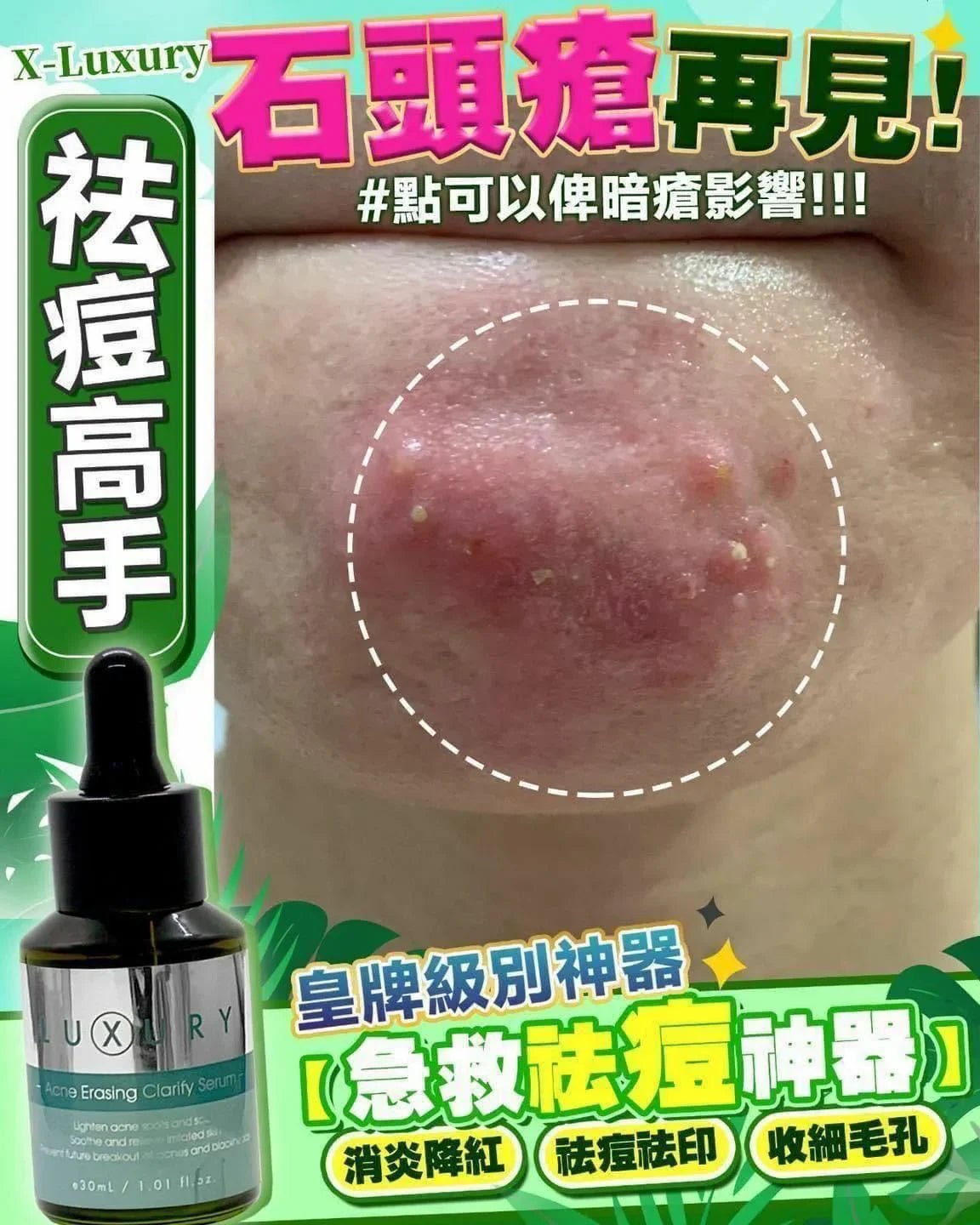 X - Luxury女皇奇蹟粉刺水 30ml - HLY &amp; CHOCCICO